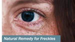 Best natural remedy for Freckles, dark circles and spots