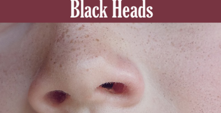 Black head removal Home Remedy